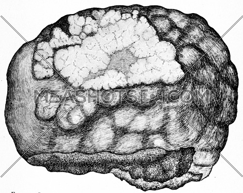 Part of left lobe of the liver, showing primary cylindric cell carcinoma, vintage engraved illustration.