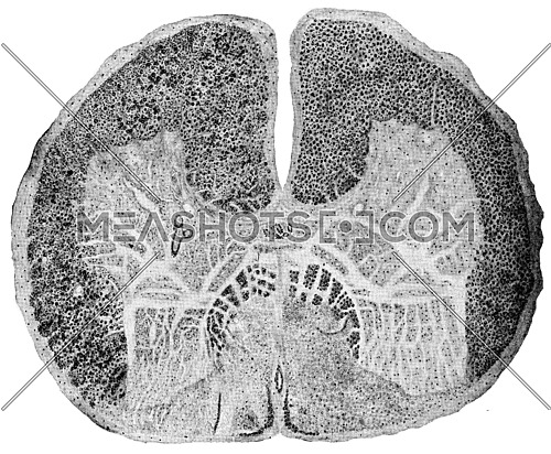 Spinal cord showing posterior sclerosis, vintage engraved illustration.
