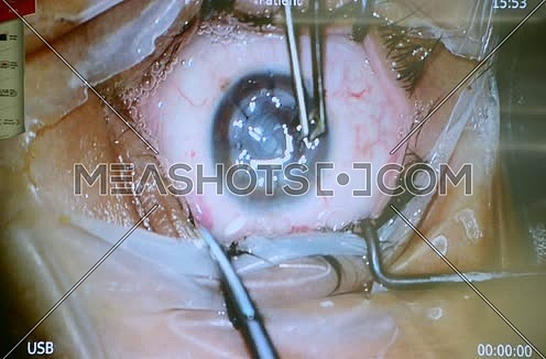 close up of eye procedure in operating room
