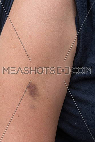 Hematoma, bruise on woman arm, pain concept closeup.