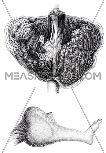 Anatomy of encephaloid tumor that requires amputation at the thigh, vintage engraved illustration.