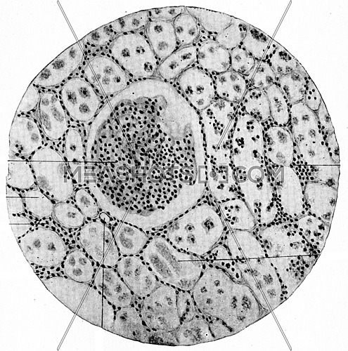 Chronic parenchymatous nephritis, vintage engraved illustration.