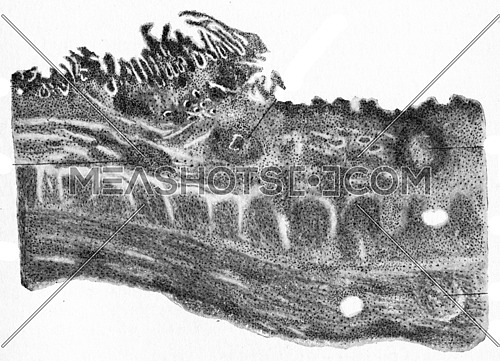 Margin of tubercular ulcer of the intestine, vintage engraved illustration.