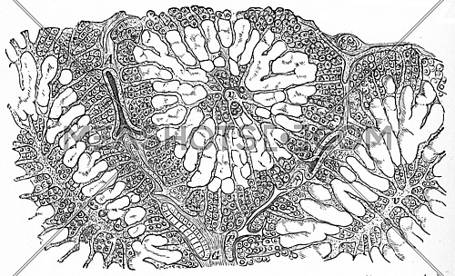 Liver, amyloid infiltration, vintage engraved illustration.