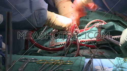 close up shot for doctors hands perfoming heart surgery
