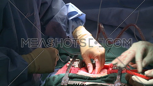 meduim shot ffor two surgeons using medical equipments during open heart surgery
