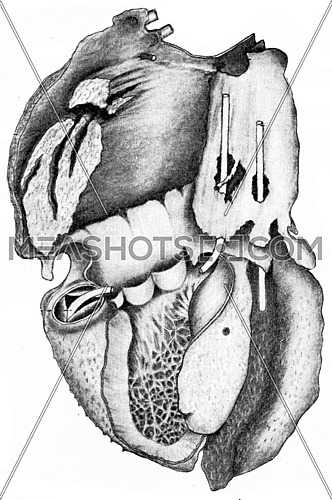 Heart showing villous pericarditis, vintage engraved illustration.