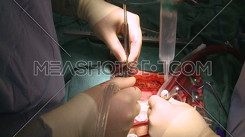 Close shot for two doctors doing Irrigation during open heart surgery 