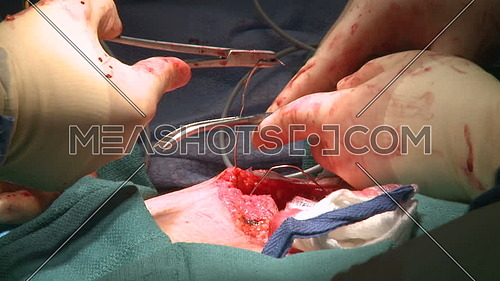 Close up shot for Surgeon hand using wire to stitch ribc age after surgery