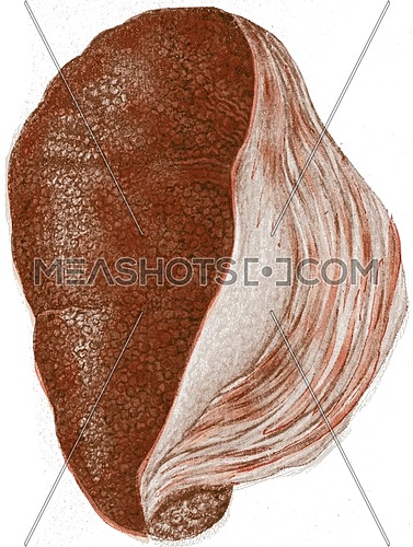 Kidney, chronic interstitial nephritis, vintage engraved illustration.