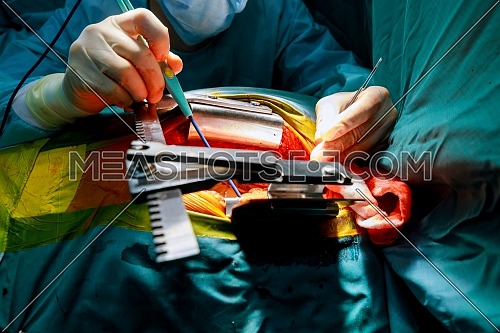 The surgeon makes an surgeon in operation room with blood operation.