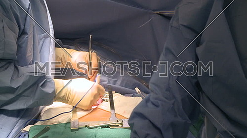 medium shot for a Surgeon hand uses electrocauterization tool during surgery