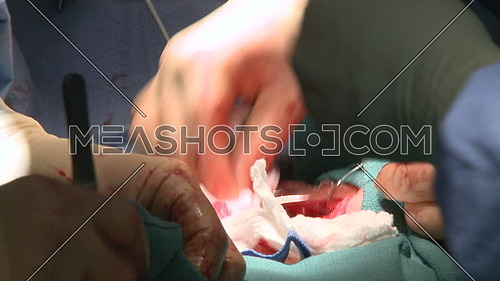 Close up shot for Surgeon hand using wire to stitch ribc age after surgery