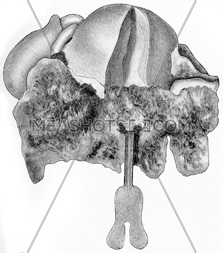 Cylindric-cell epithelioma of the cervix uteri, vintage engraved illustration.