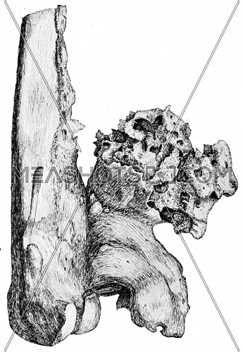 Osteophytes on the popliteal aspect of the lower end of the femur, vintage engraved illustration.