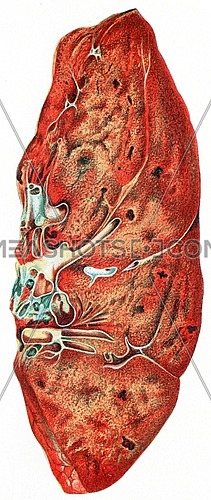 Lung, croupous pneumonia, vintage engraved illustration.