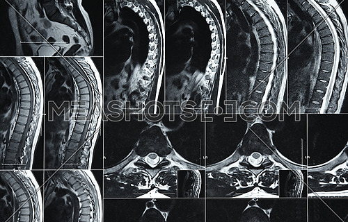 Close up magnetic resonance imaging or computed tomography scan of human lumbar spine