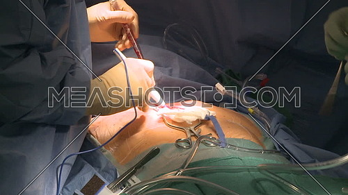 close shot for Surgeon's hand uses electrocauterization to stop bleeding during heart surgery