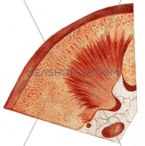 Kidney, acute parenchymatous nephritis, vintage engraved illustration.