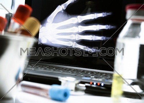 Hand radiography in hospital, conceptual image