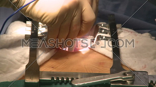 close up shot for surgeon hand while doing a heart surgery