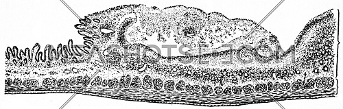 Section through a typhoid ulcer, end of second week of the disease, vintage engraved illustration.