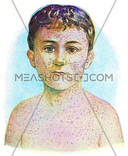 Measles illness, antique color vintage illustration.