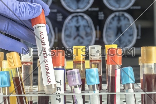 Scientist holds blood sample to investigate remedy against Alzheimer's disease, conceptual image