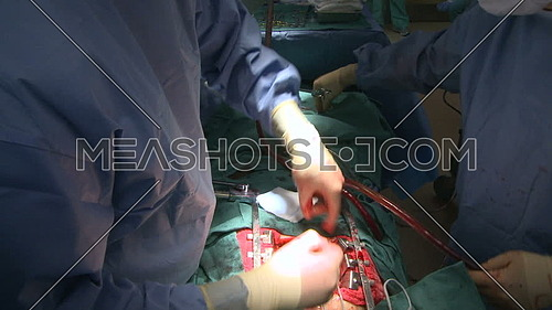 Close up shot for Doctor hand stitching internal incision during open heart surgery