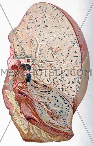 Lung, croupous pneumonia, vintage engraved illustration.