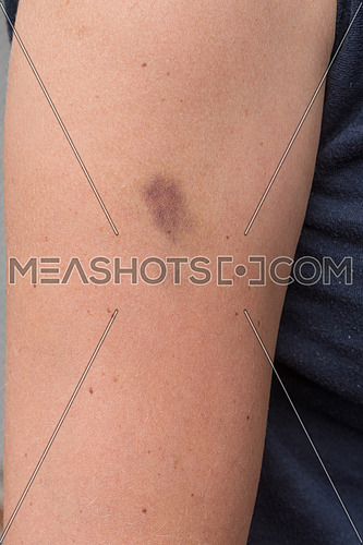 Hematoma, bruise on woman arm, pain concept closeup.