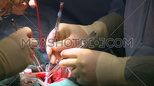 Close shot for two Doctors hands perform heart surgery
