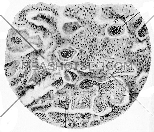 Giant cell sarcoma, vintage engraved illustration.
