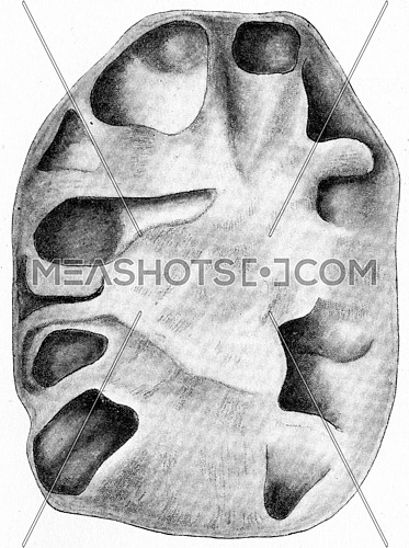 Tuberculous pyelonephritis, chronic ascending tuberculosis of the kidney, vintage engraved illustration.