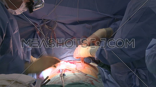 Medium shot for doctor putting gauze into chest incision during open heart surgery